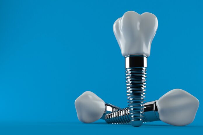 Czym się różnią implanty od protez zębowych?